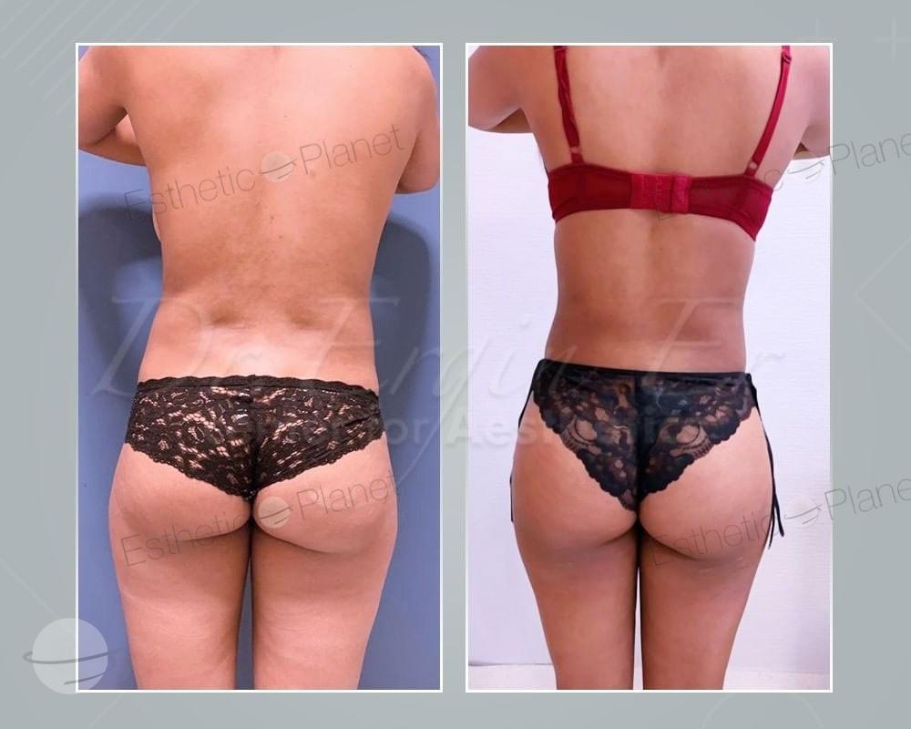 Lipofilling_des_fesses_BBL