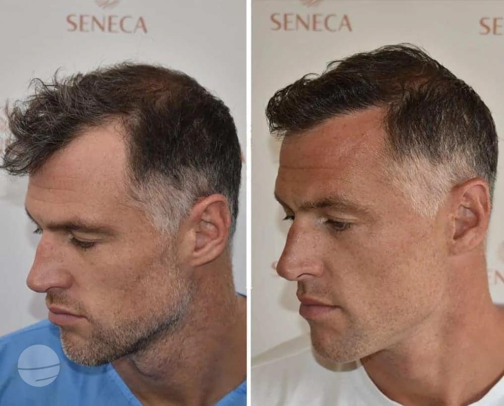 FUE by Doctor