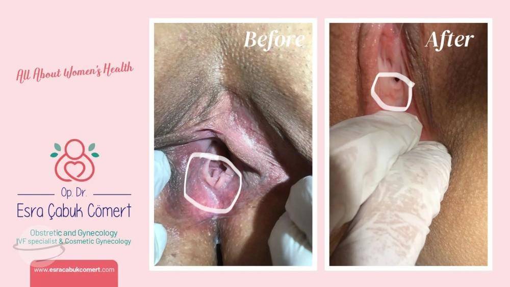 Hymenoplastie