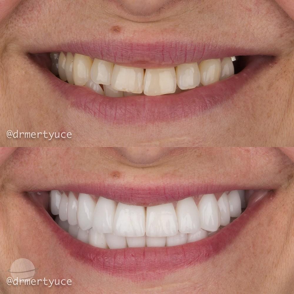 Veneers by Dentaglobal