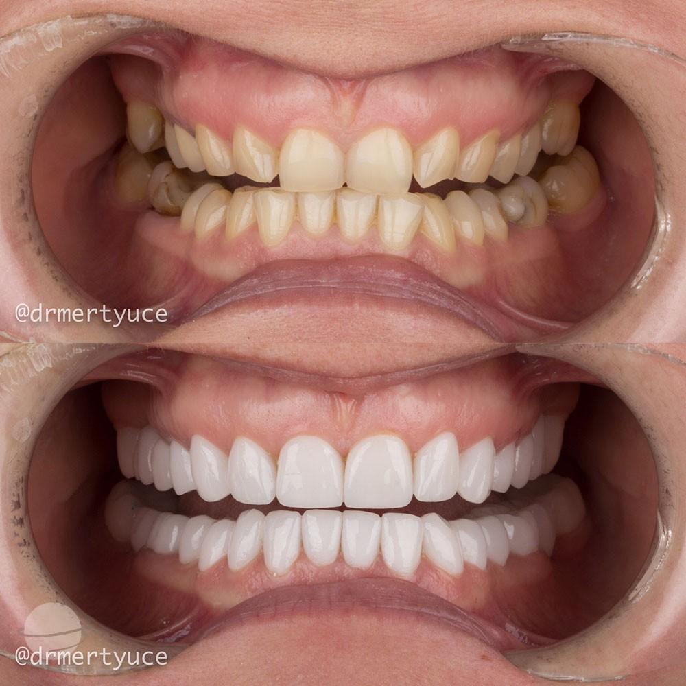 Veneers by Dentaglobal