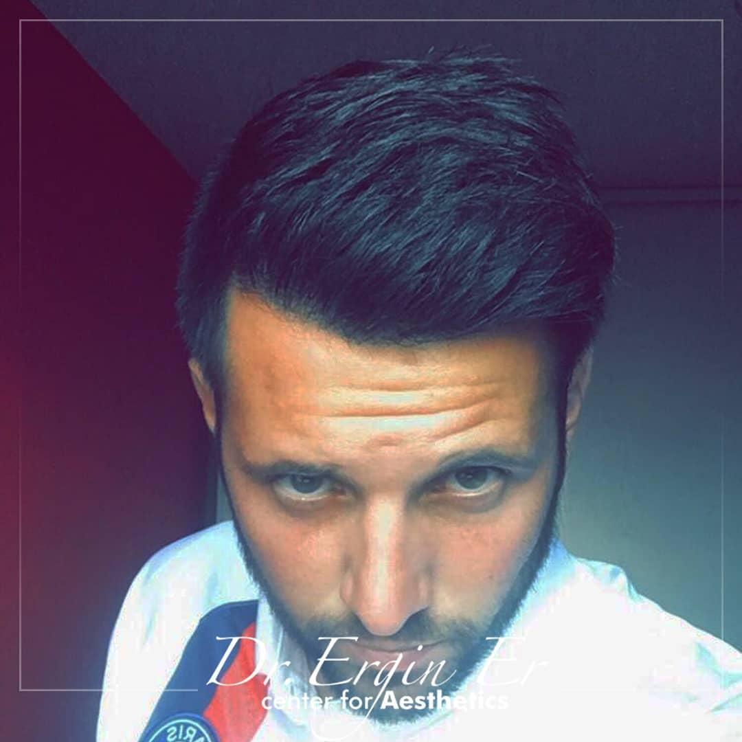 FUE Hair transplant By Esthetic Planet Team