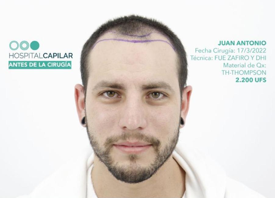 hospital-capillar-before-and-aftersJuan-Antonio-Antes