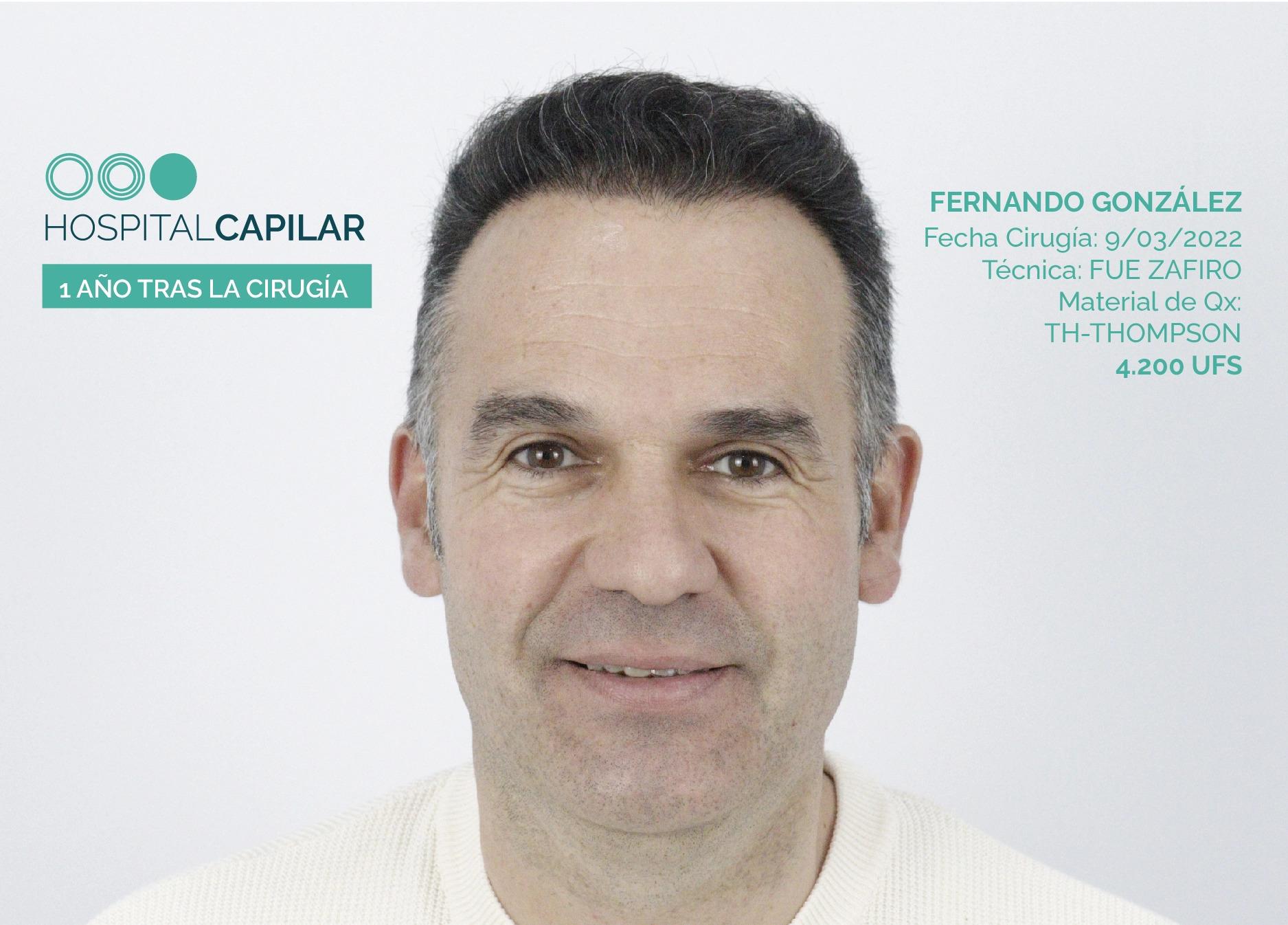 hospital capillar results hair transplant