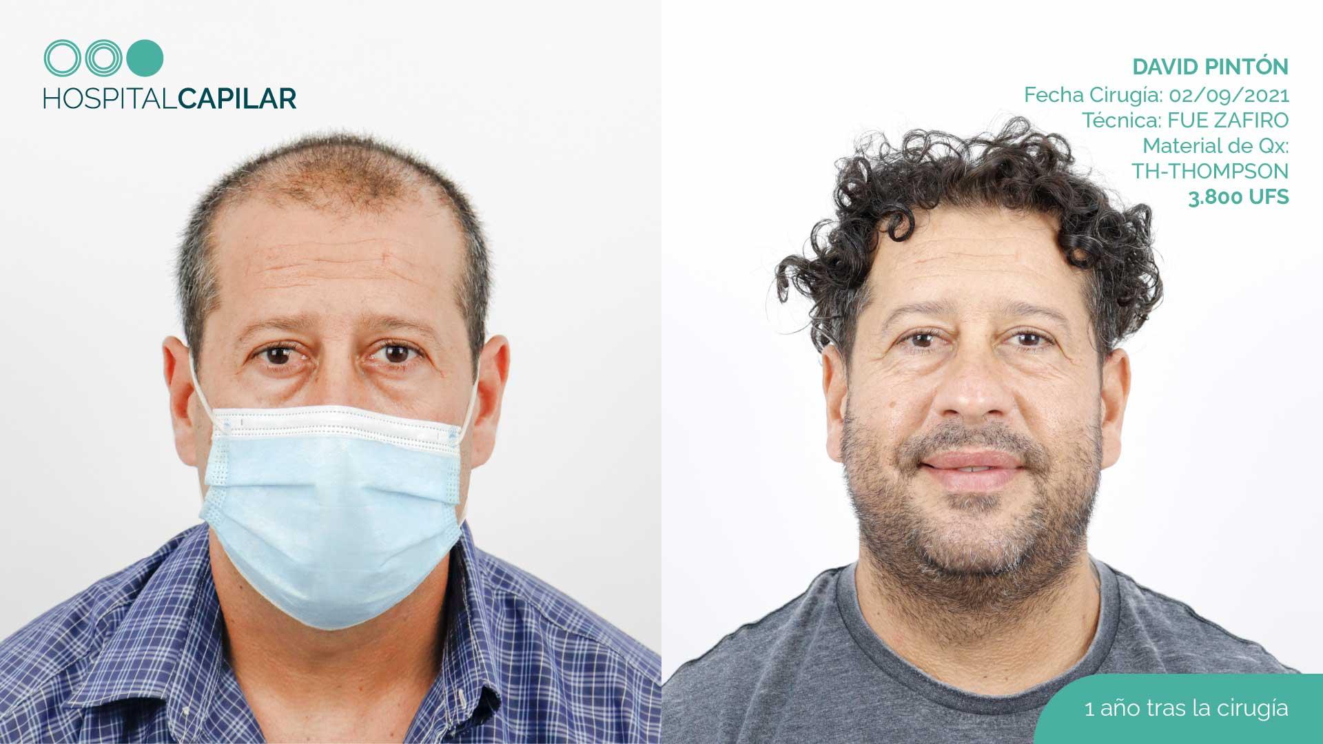 hospital capillar before and after hair transplant