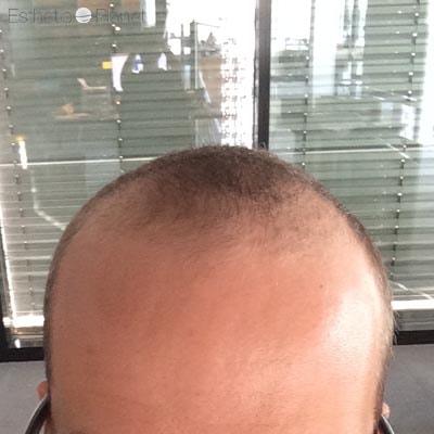 Before FUE CASE 2