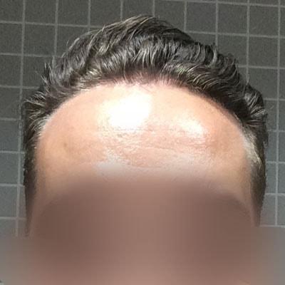 After FUE CASE 2