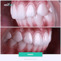 DENTSPA ISTANBUL EMAX VENEERS4