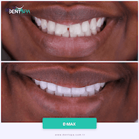 DENTSPA ISTANBUL EMAX VENEERS10