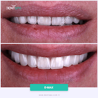 DENTSPA ISTANBUL EMAX VENEERS5