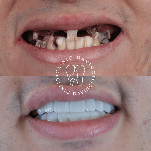 Da Vinci hollywood smiles2