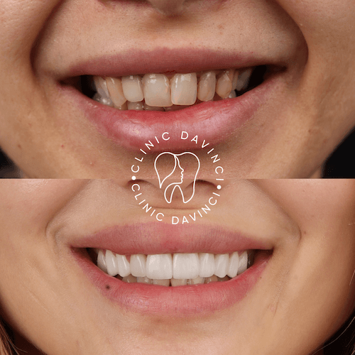 Da Vinci hollywood smiles1