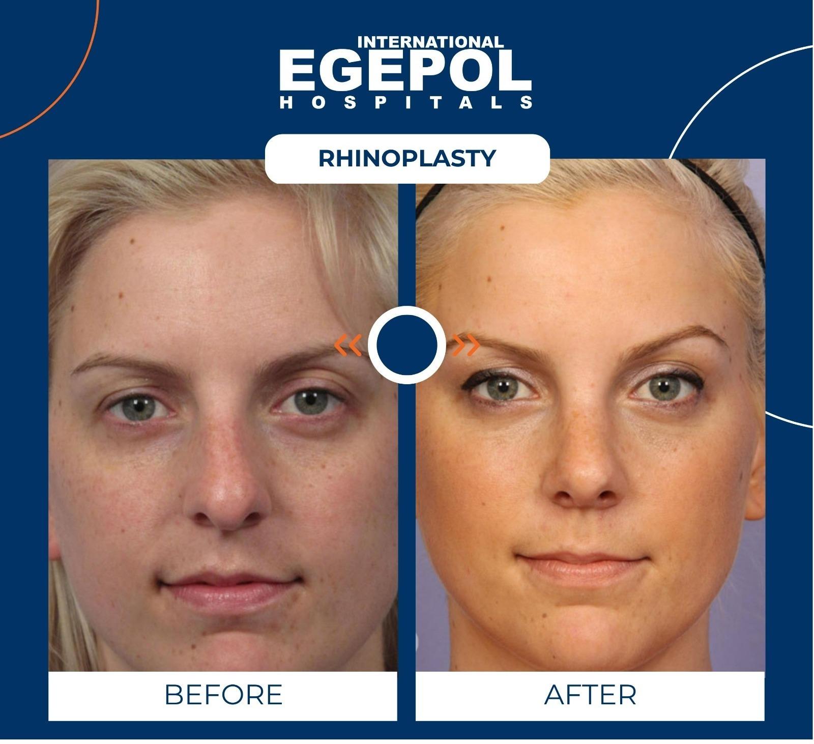 Rhinoplasty by Egepol 3