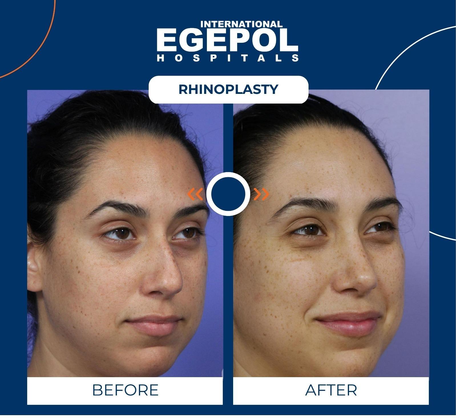 Rhinoplasty by Egepol 4