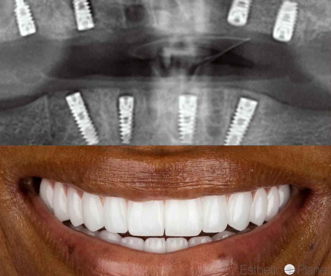 Zirconium Crows by Dentaglobal