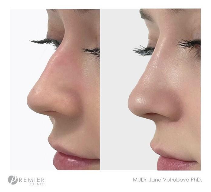 Rhinoplasty by Premier Clinic