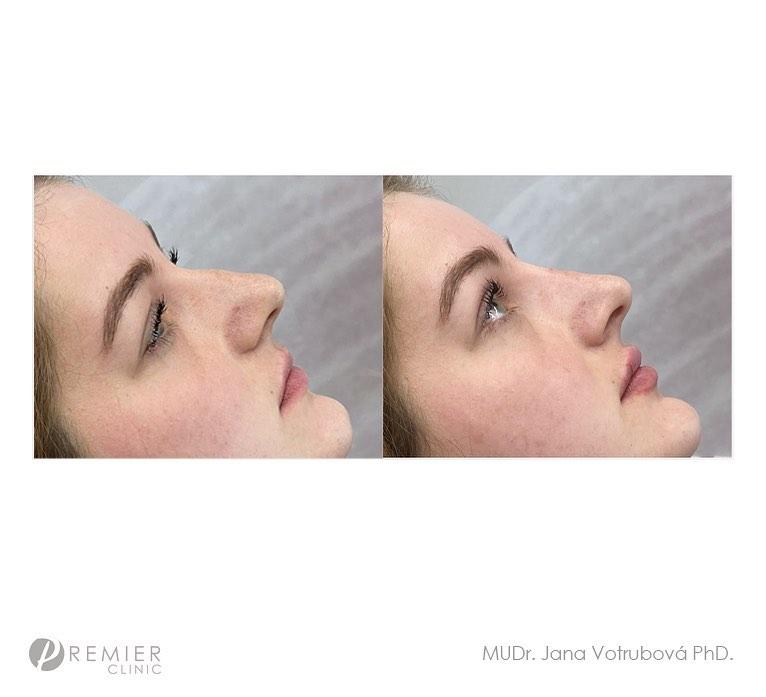 Rhinoplasty by Premier Clinic