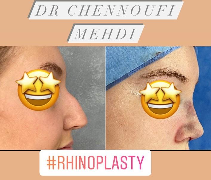 Rhinoplasy Mehdi Chennoufi 2