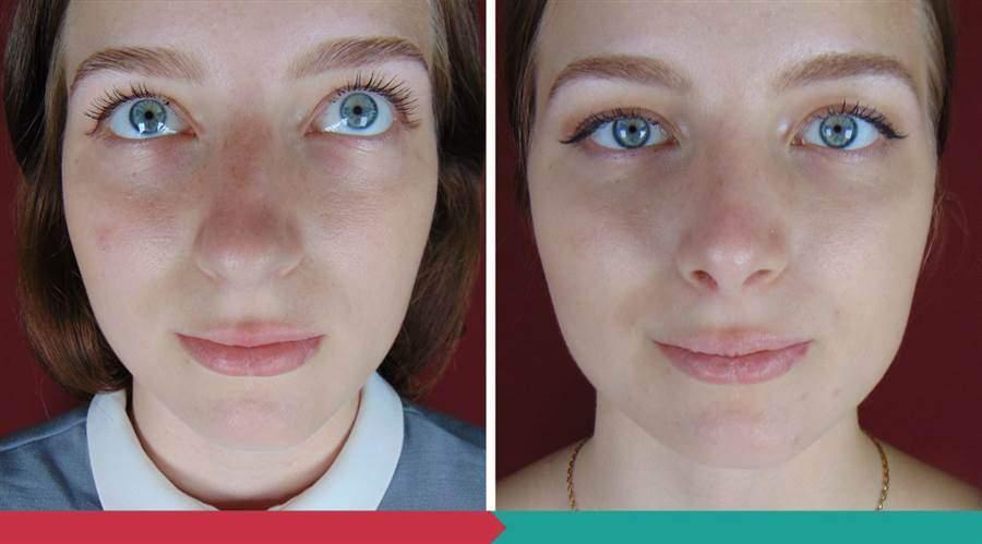 Rhinoplasty ABClinic Praha6