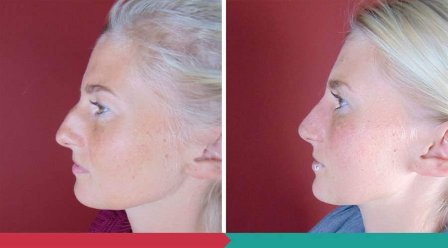 Rhinoplasty ABClinic Praha7