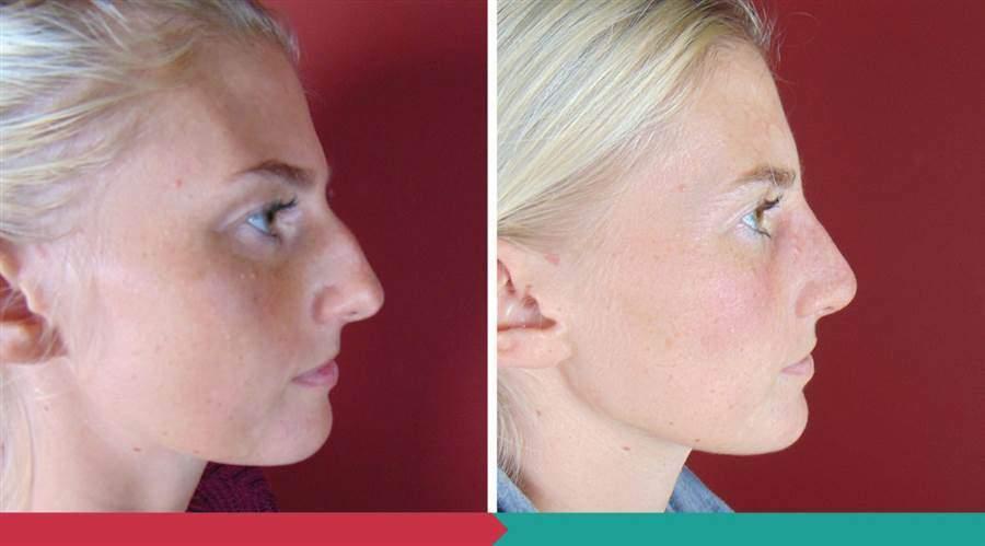 Rhinoplasty ABClinic Praha8
