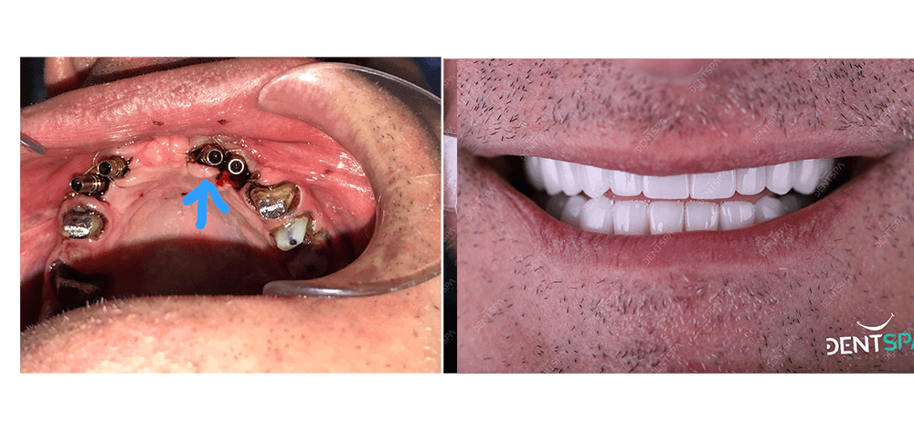 Implants dentspa 2