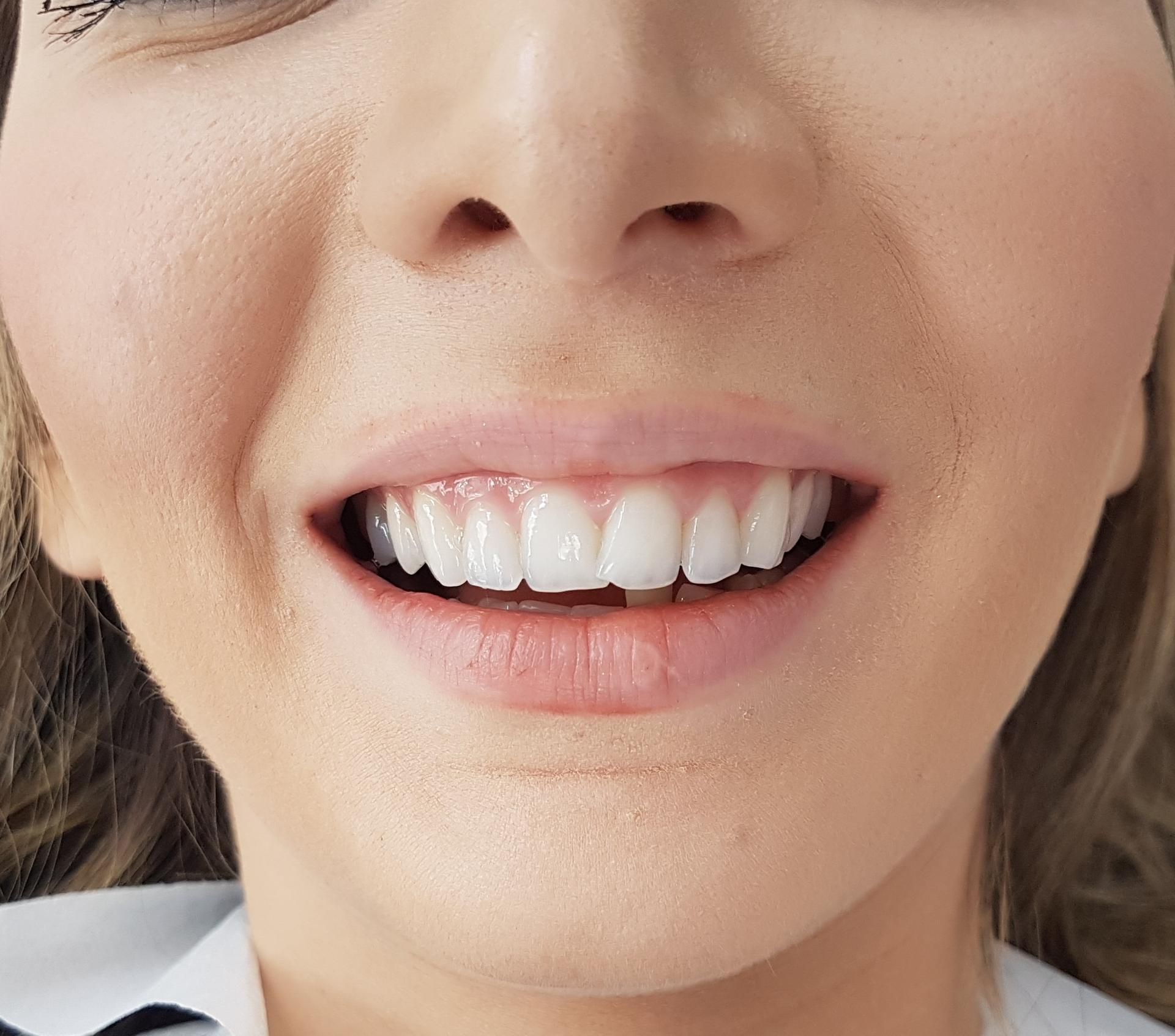 Before Veneers / Avant facettes