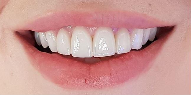 After Veneers / Après facettes