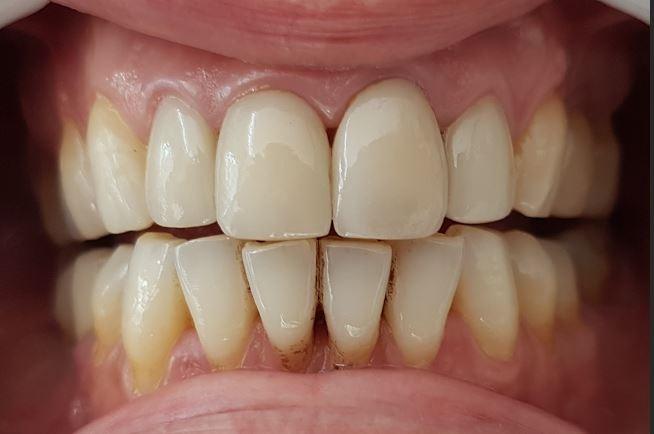 Before Veneers / Avant facettes