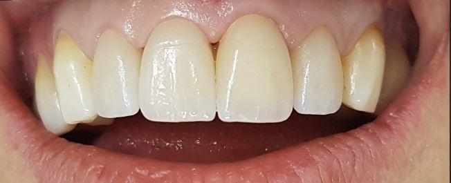 After Veneers / Après facettes