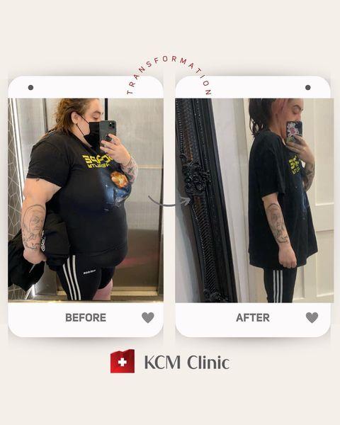 Weightloss at KCM clinic