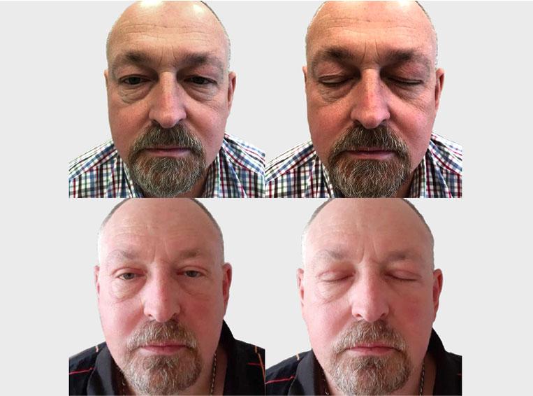 blepharoplasty by Premier Clinic