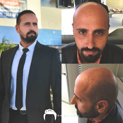 HairGlobal hair results21