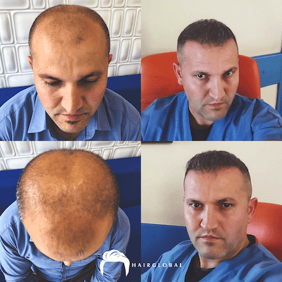 HairGlobal hair results20