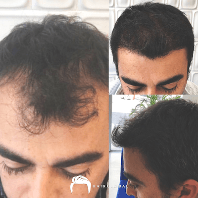 HairGlobal hair results19