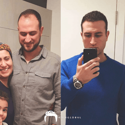 HairGlobal hair results16