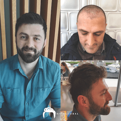 HairGlobal hair results6