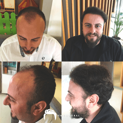 HairGlobal hair results4