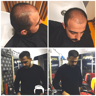 HairGlobal hair results2