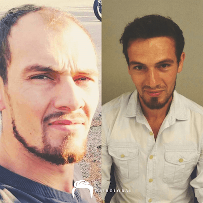 HairGlobal hair results14