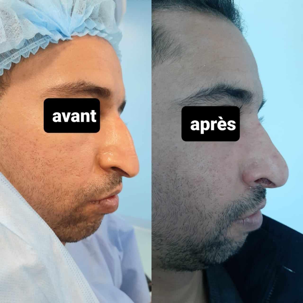 RHINOPLASTIE TUNISIE ZAGHOUAN1