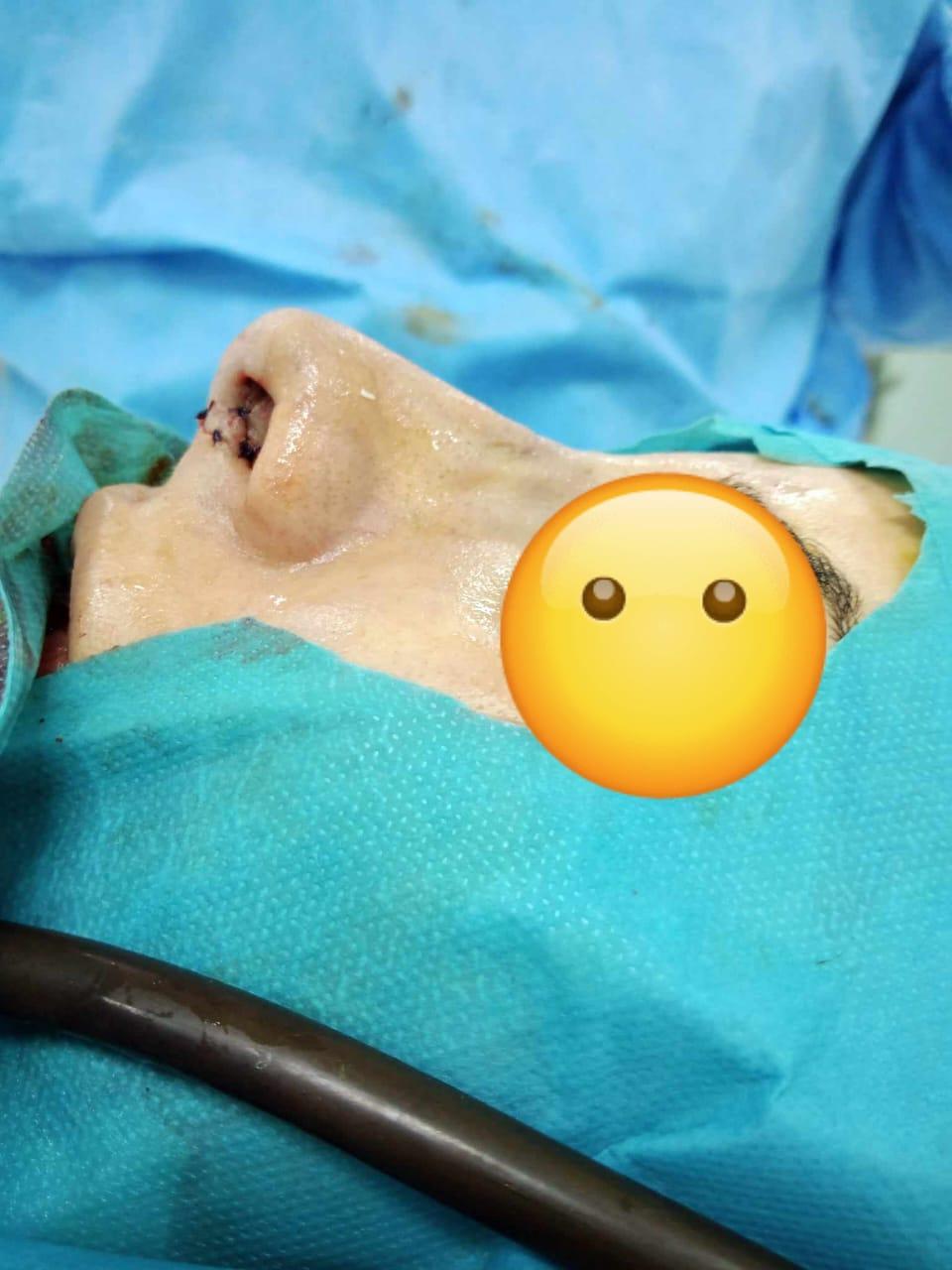 RHINOPLASTIE TUNISIE ZAGHOUAN5