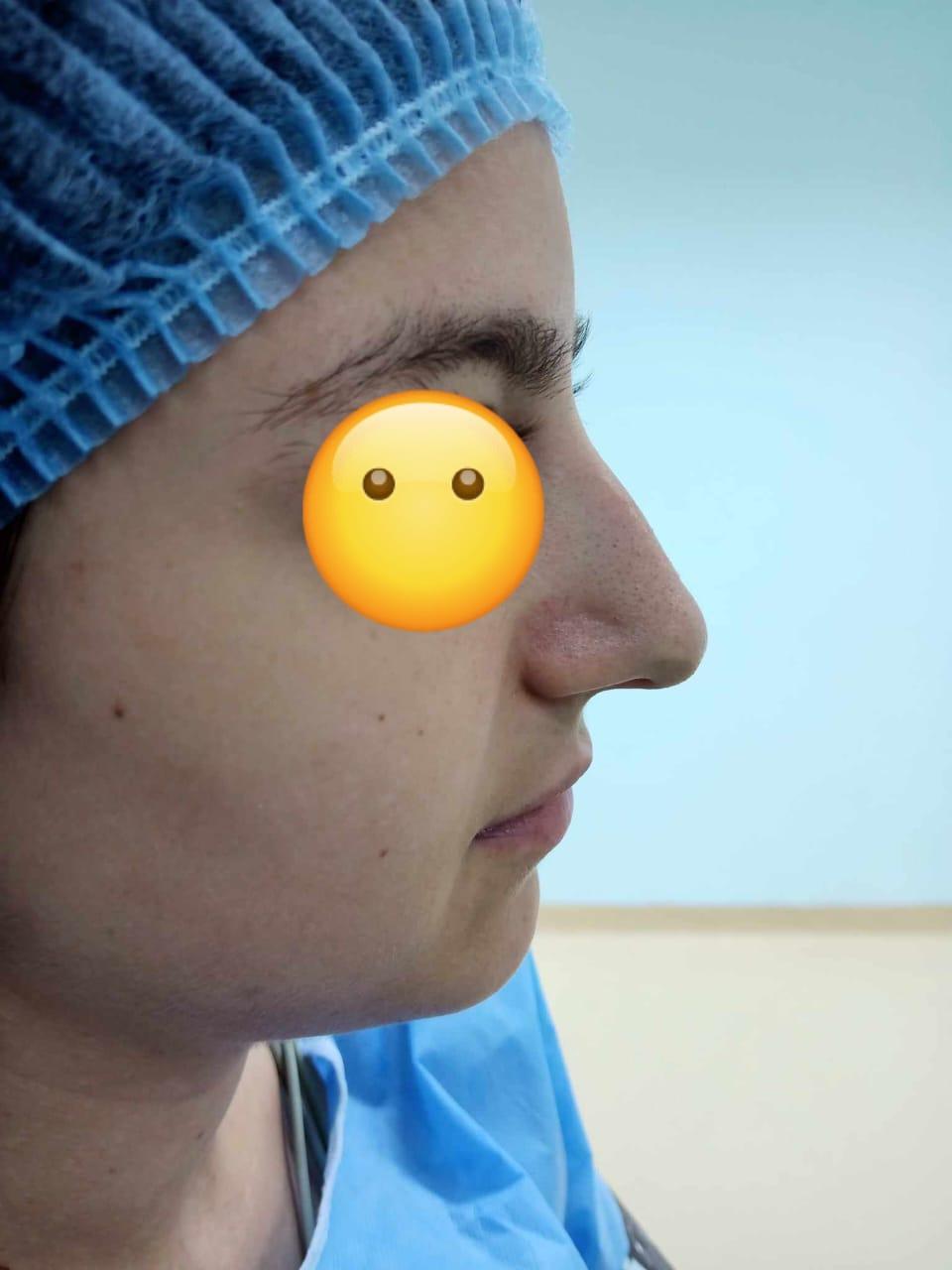 RHINOPLASTIE TUNISIE ZAGHOUAN4