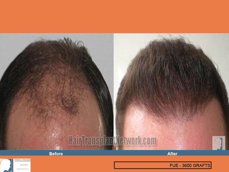 Dr Patrick Mwamba Hair transplant result