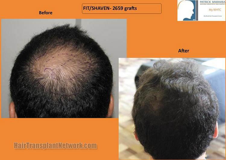 Dr Patrick Mwamba Hair transplant result