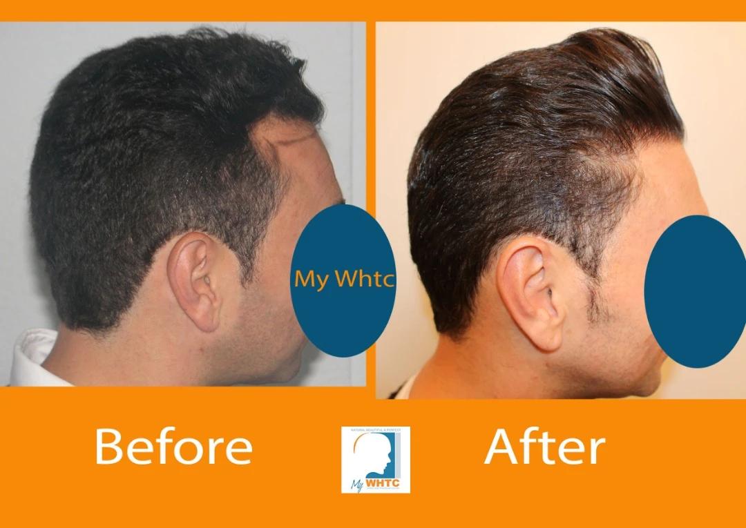 Dr Patrick Mwamba Hair transplant result