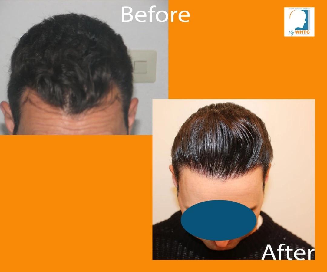 Dr Patrick Mwamba Hair transplant result