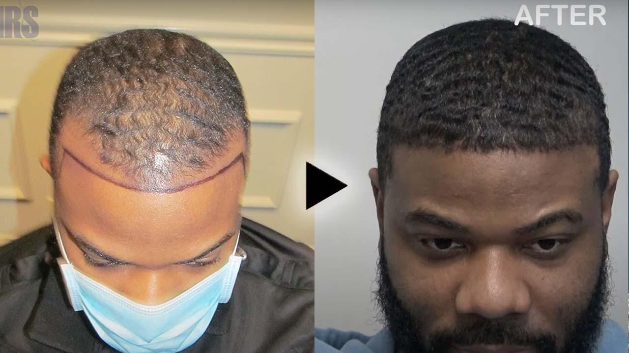 Dr Patrick Mwamba Hair transplant result