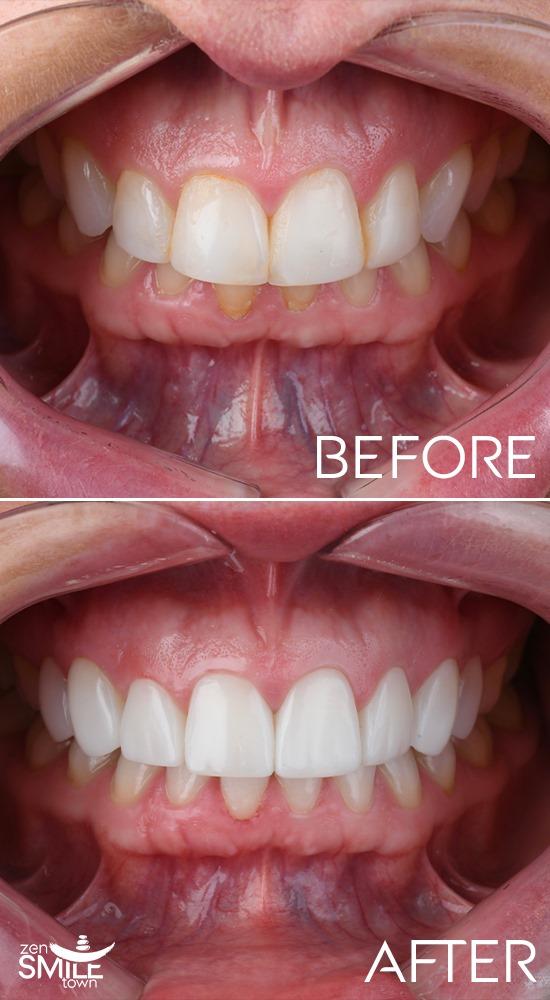 DENTAL TURKEY - COMPOSITE BONDING RESULTS1