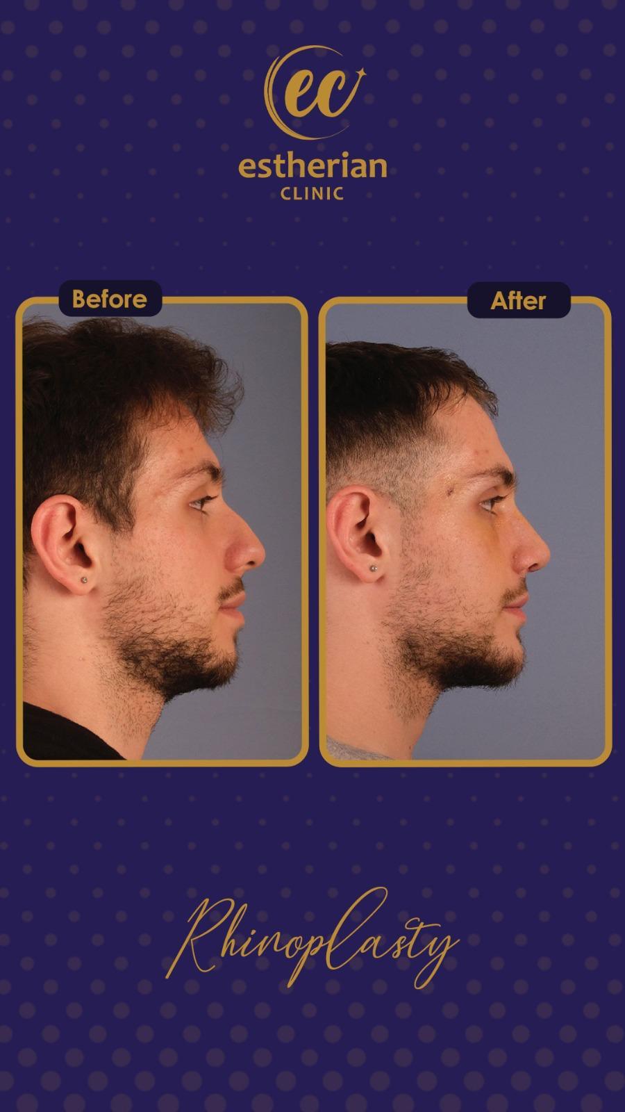 estherian Face Surgery 14-min